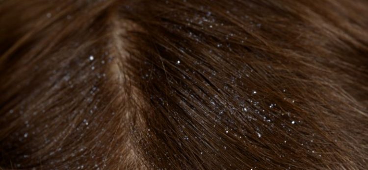 What are the home remedies to cure dandruff naturally? 